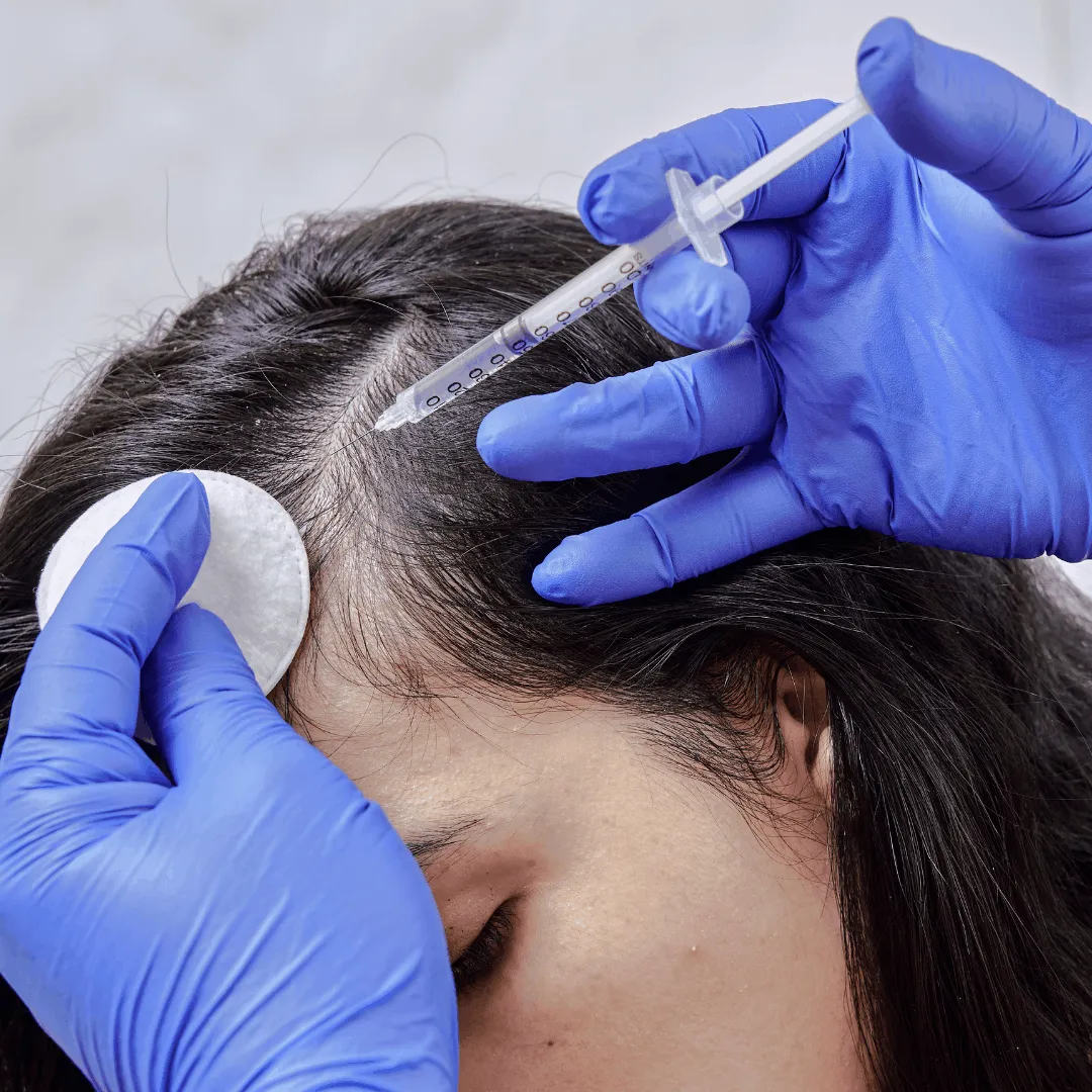 PRP hair treatment consultation at Vedara Care JVC Dubai with consultant dermatologist