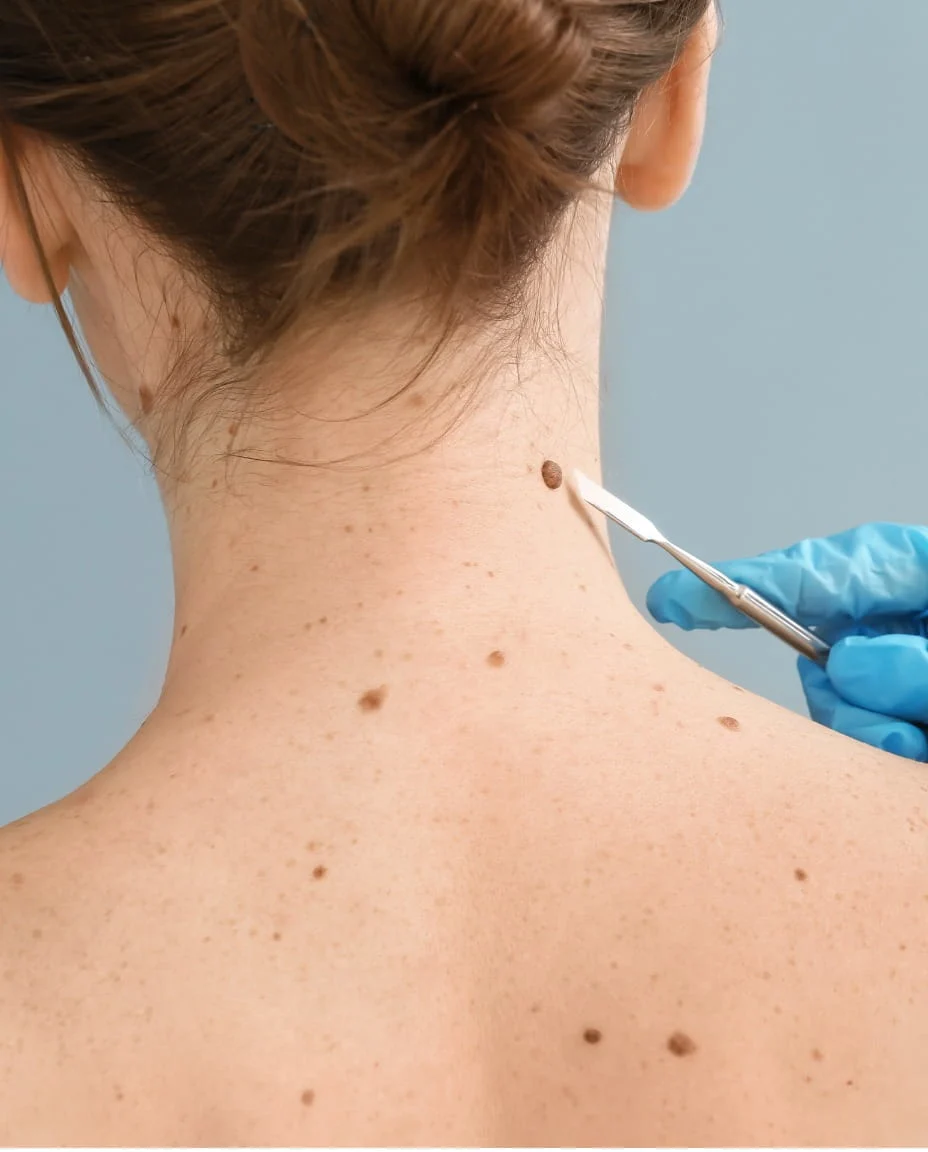 Skin Tag Removal in JVC dermatology assessment at Vedara Care