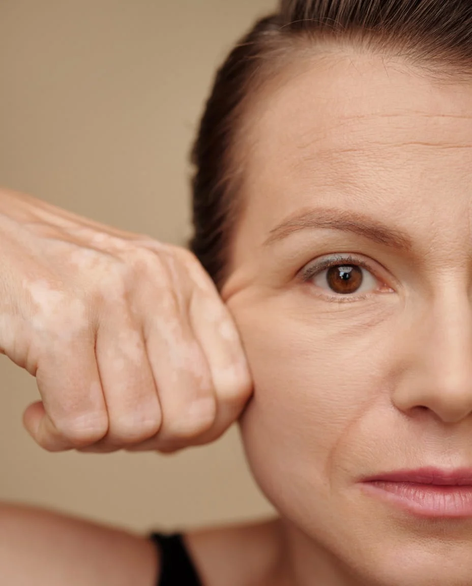 Skin tightening technologies